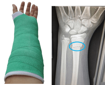 fracture
